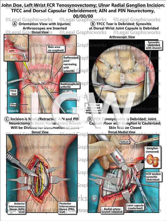 Left Wrist FCR Tenosynovectomy; Ulnar Radial Ganglion Incision; TFCC and Dorsal Capsular Debridement; AIN and PIN Neurectomy