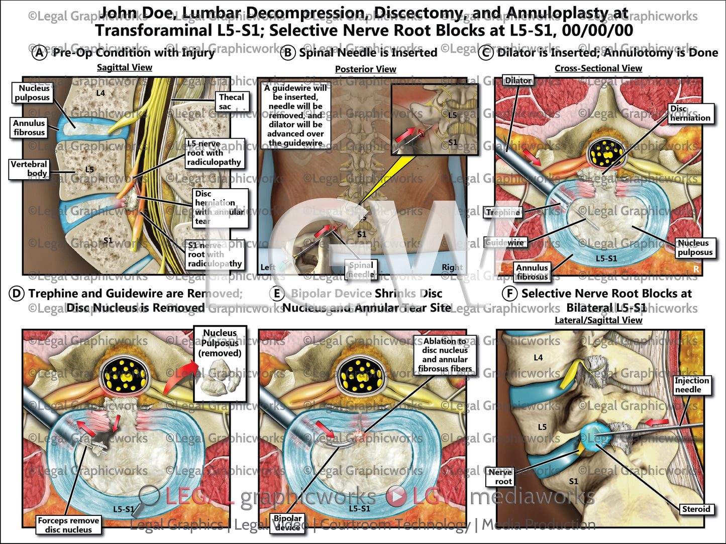 Lumbar Decompression, Discectomy, and Annuloplasty at Transforaminal L5-S1; Selective Nerve Root Blocks at L5-S1