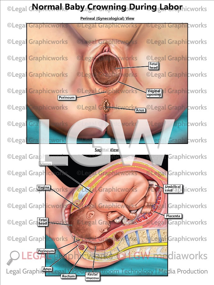 Normal Baby Crowning During Labor
