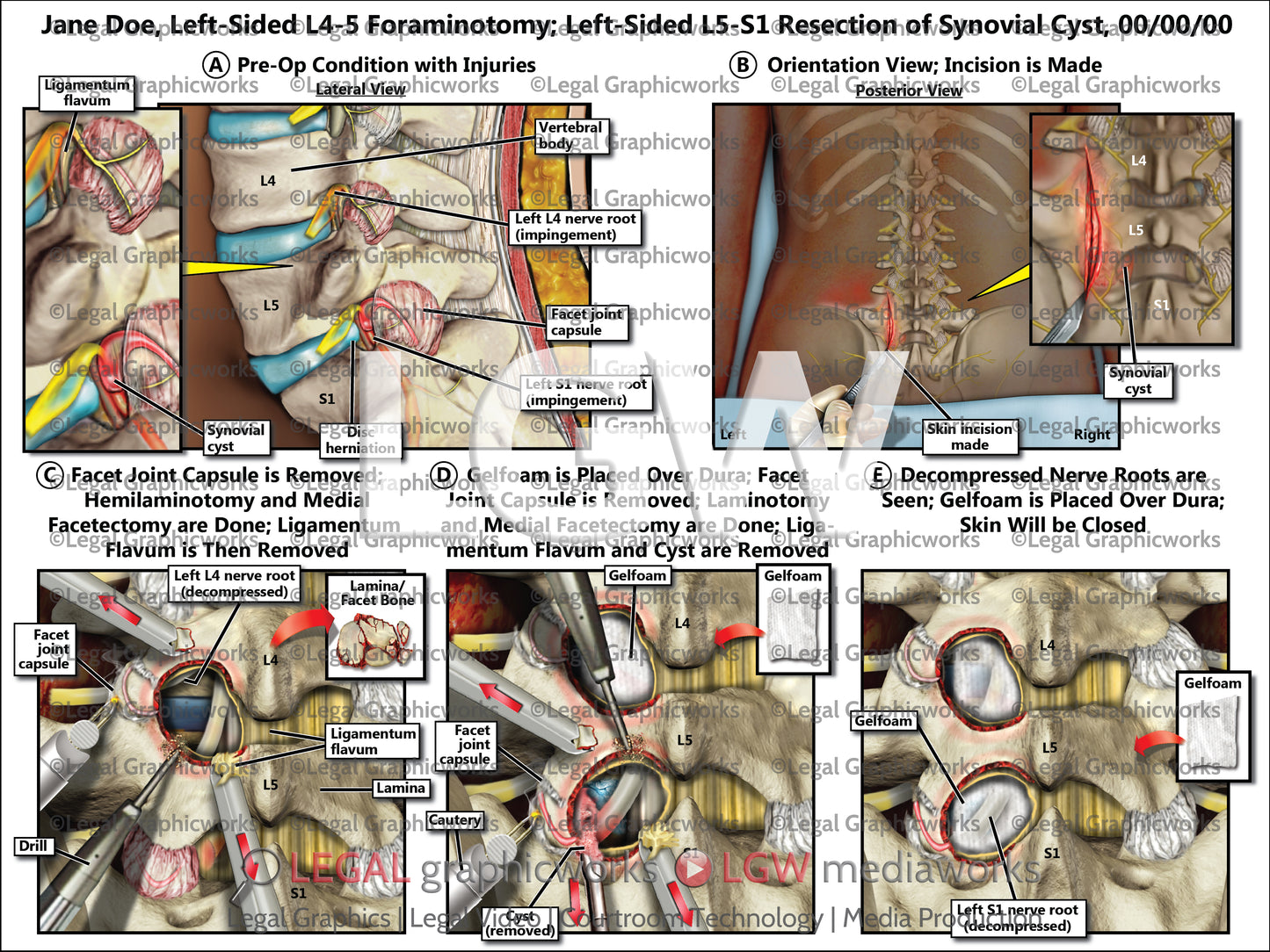 Left-Sided L4-5 Foraminotomy; Left-Sided L5-S1 Resection of Synovial Cyst