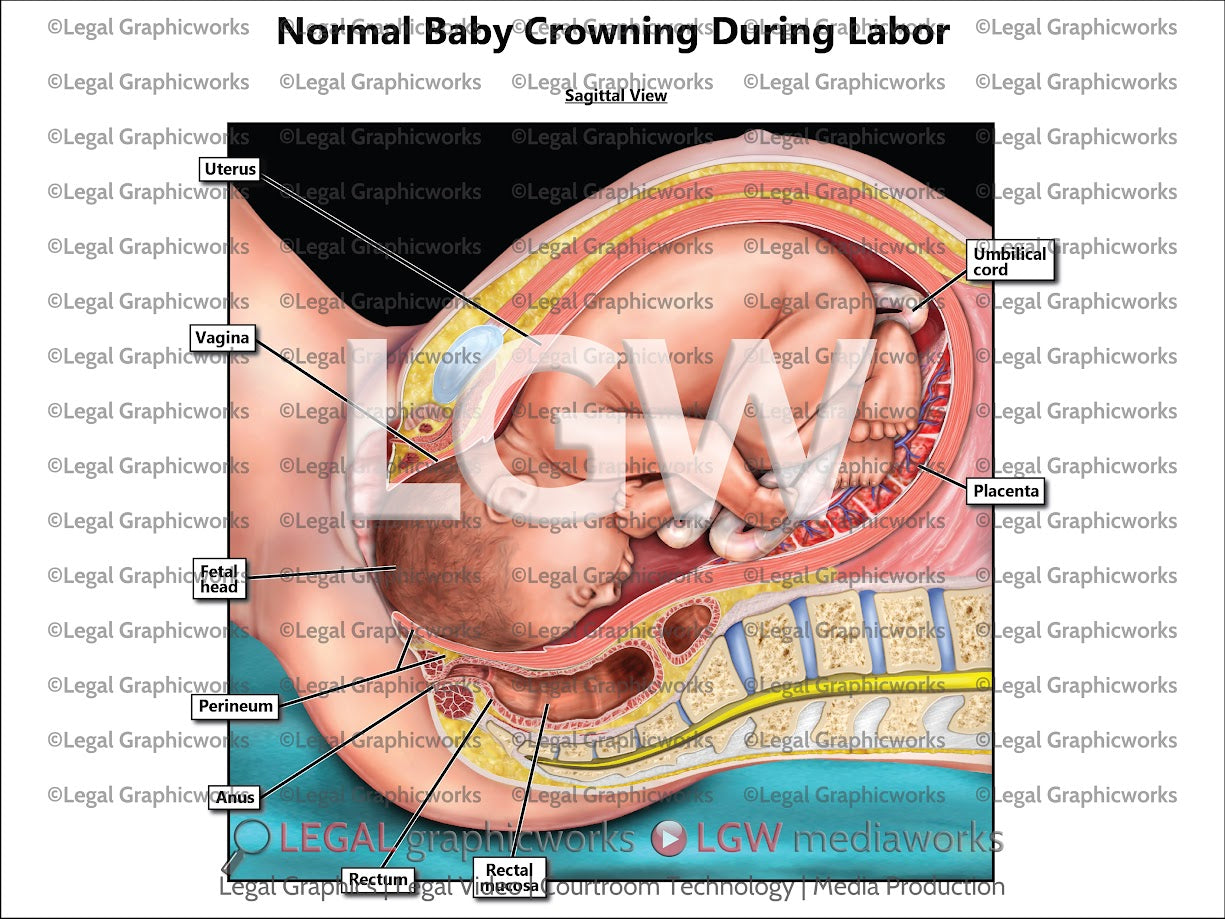 Normal Baby Crowning During Labor