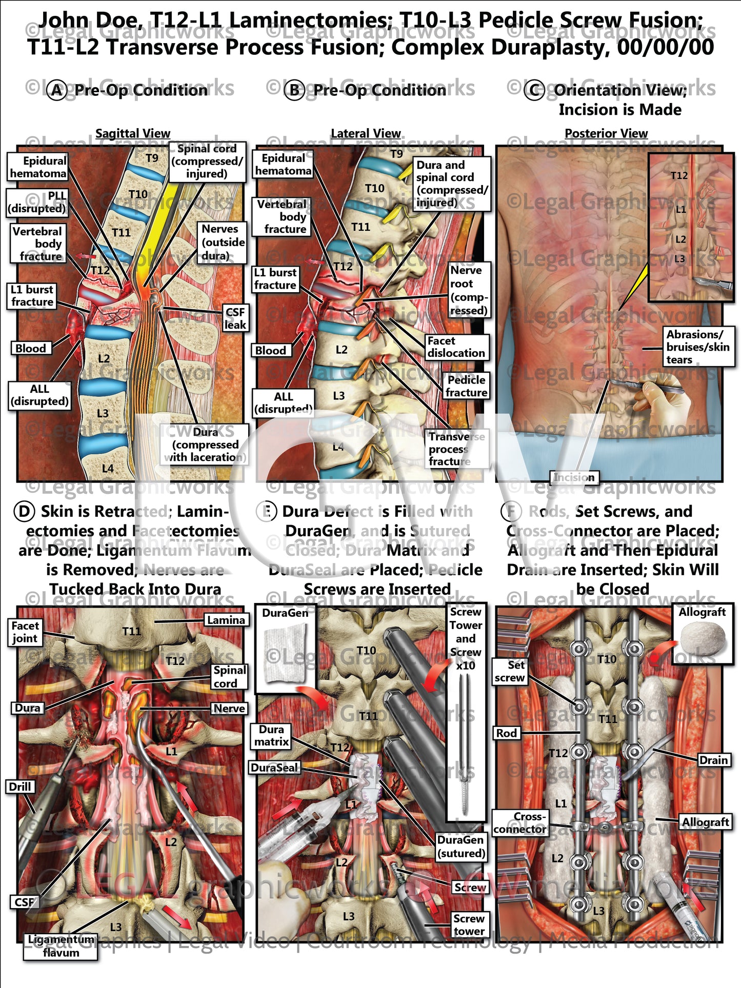 T12-L1 Laminectomies; T10-L3 Pedicle Screw Fusion; T11-L2 Transverse Process Fusion; Complex Duraplasty