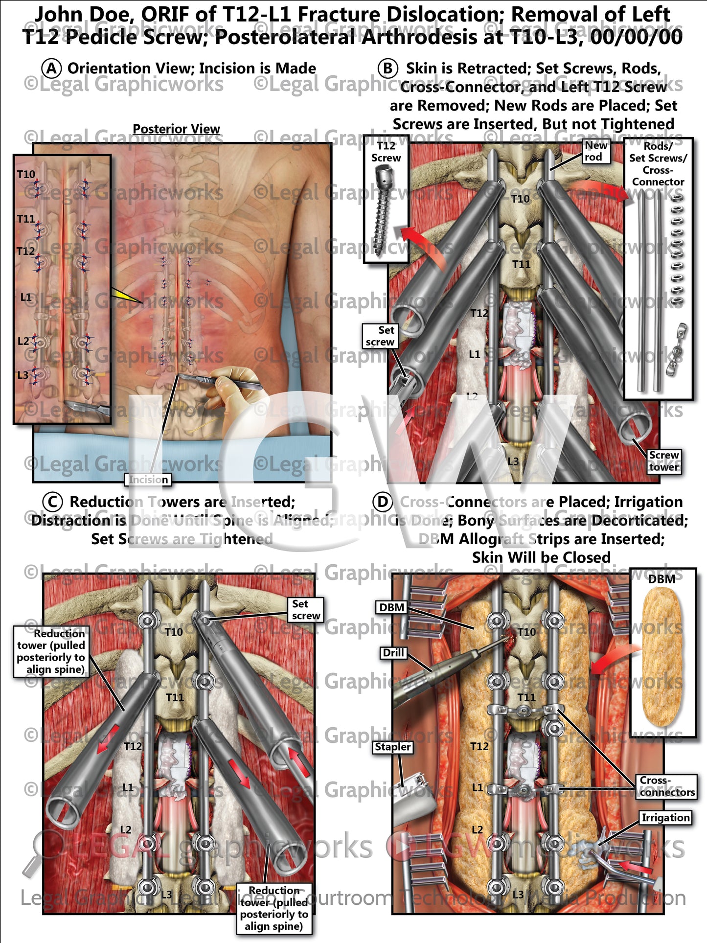 ORIF of T12-L1 Fracture Dislocation; Removal of Left T12 Pedicle Screw; Posterolateral Arthrodesis at T10-L3