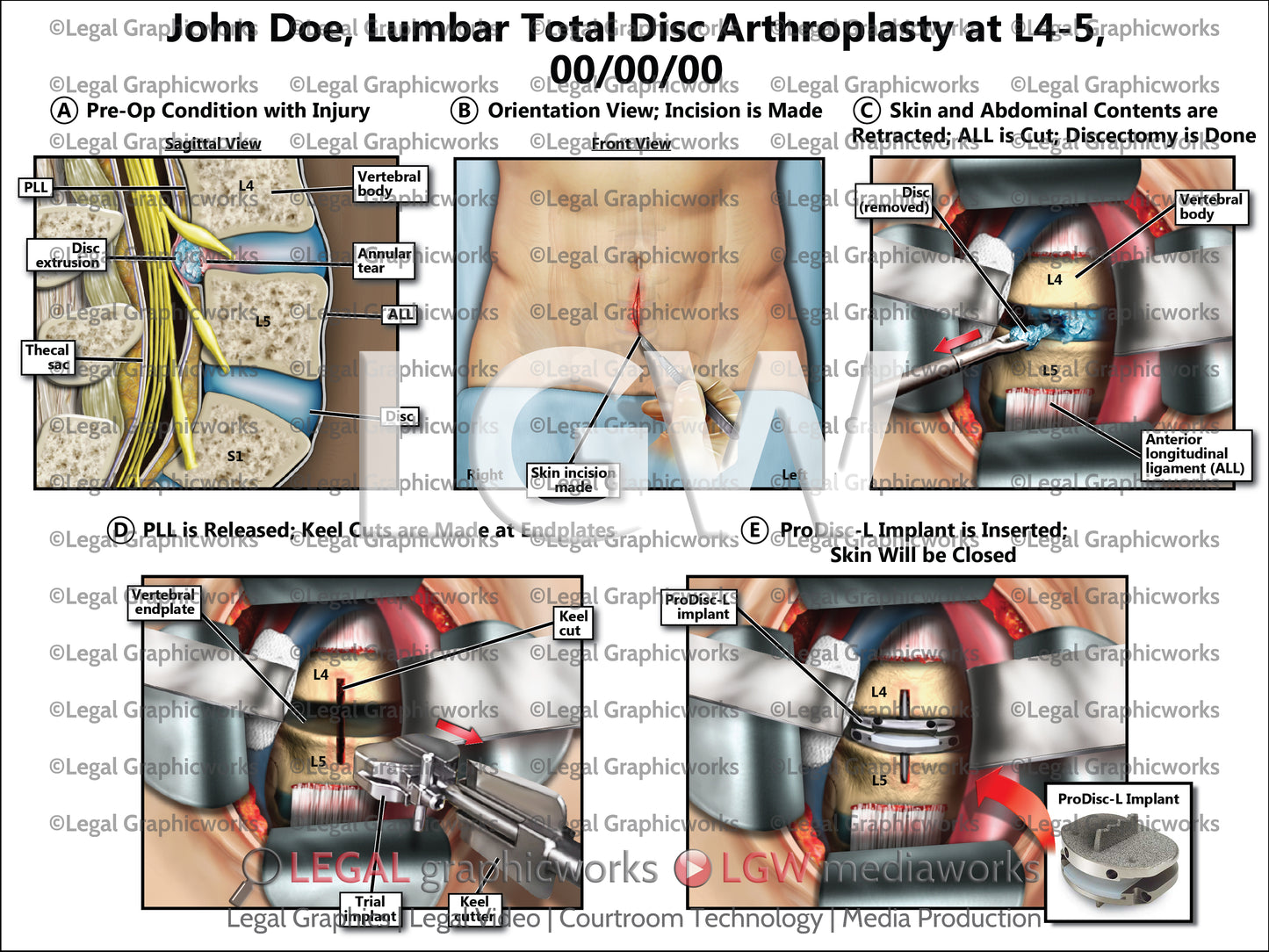 Lumbar Total Disc Arthroplasty at L4-5
