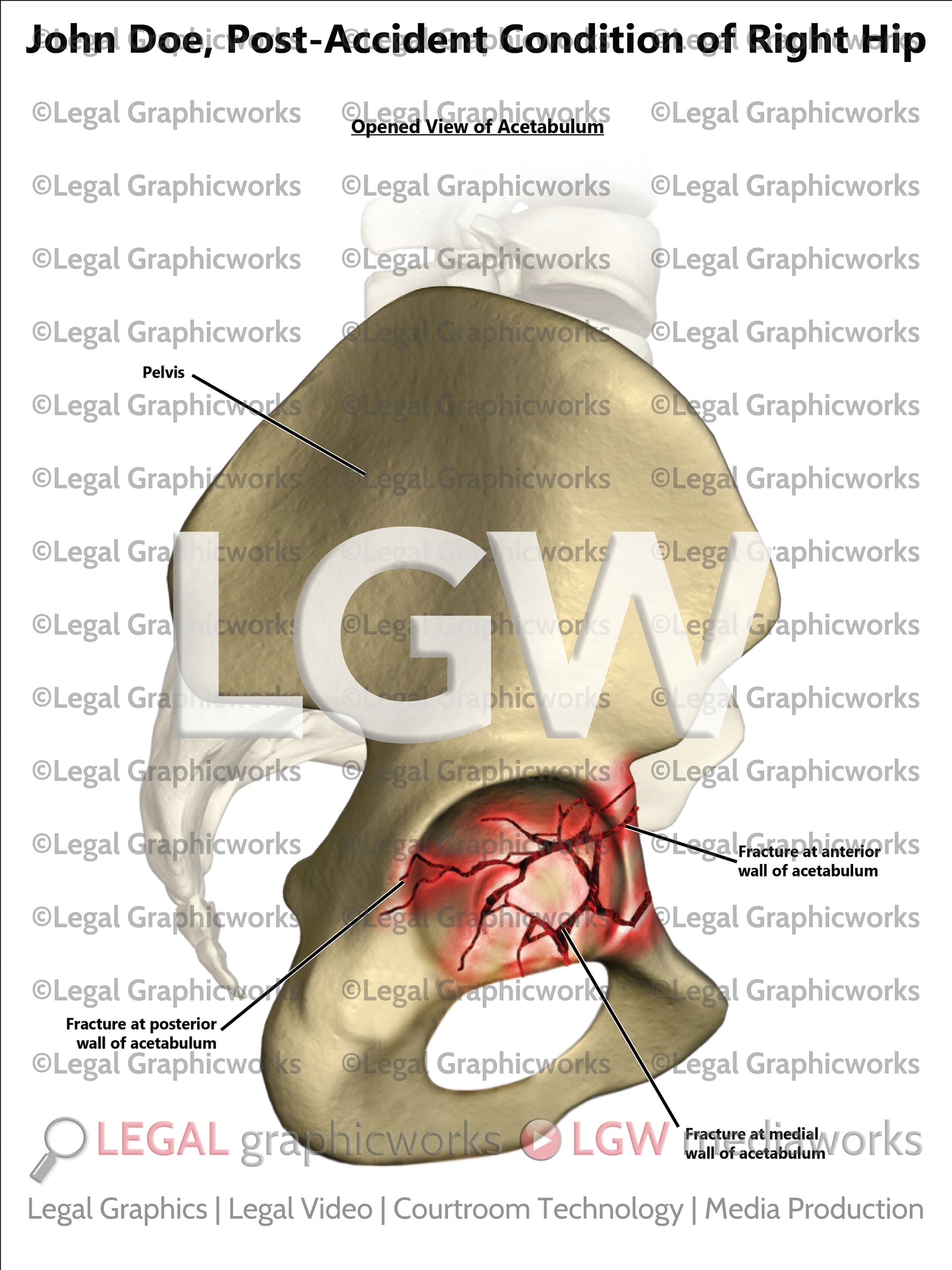 Post-Accident Condition of Right Hip