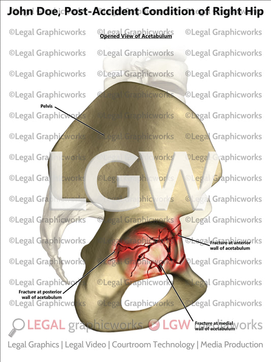 Post-Accident Condition of Right Hip