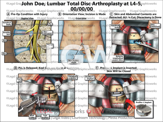 Lumbar Total Disc Arthroplasty at L4-5