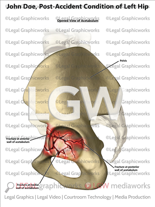 Post-Accident Condition of Left Hip