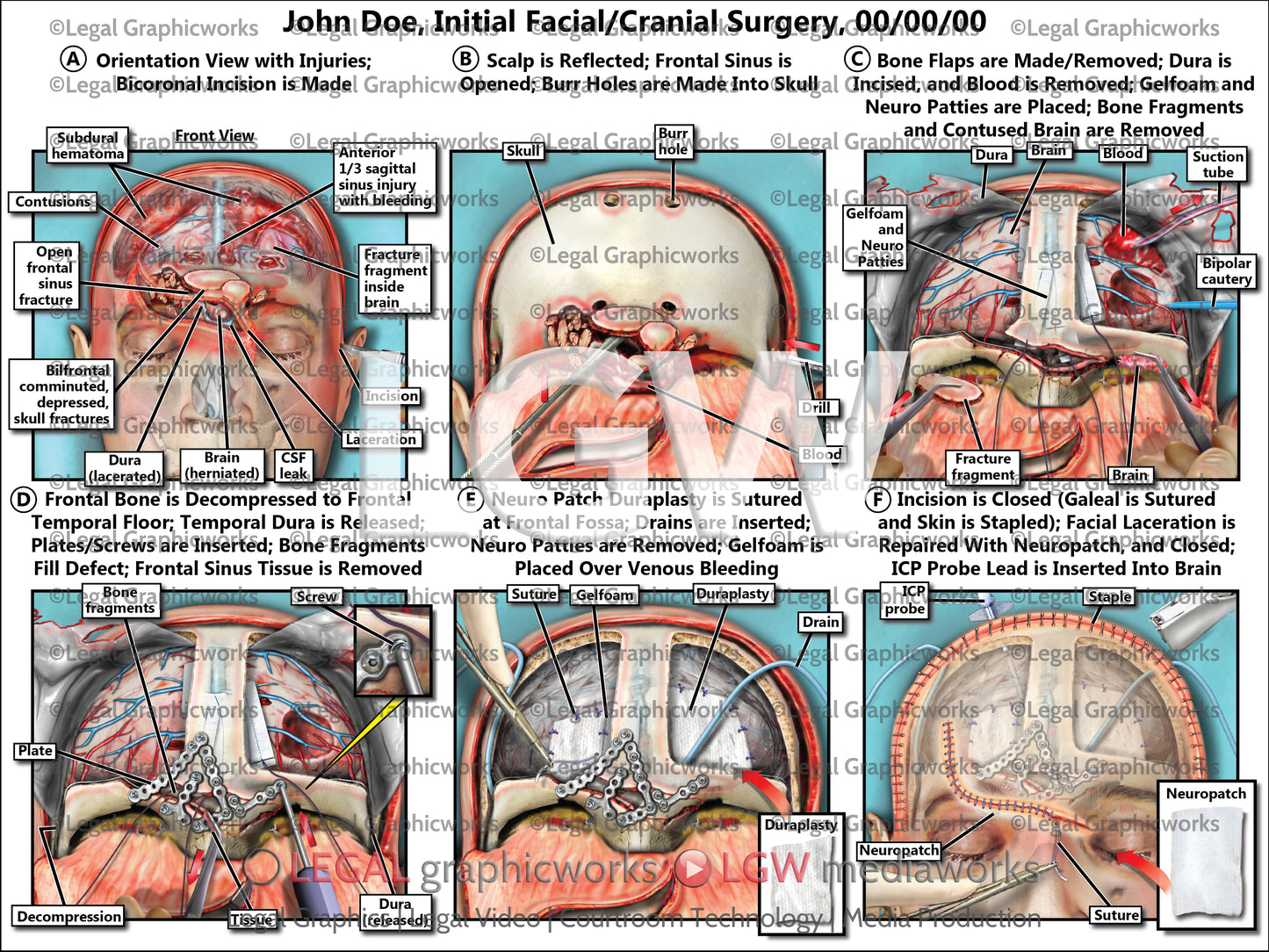 Initial Facial/Cranial Surgery