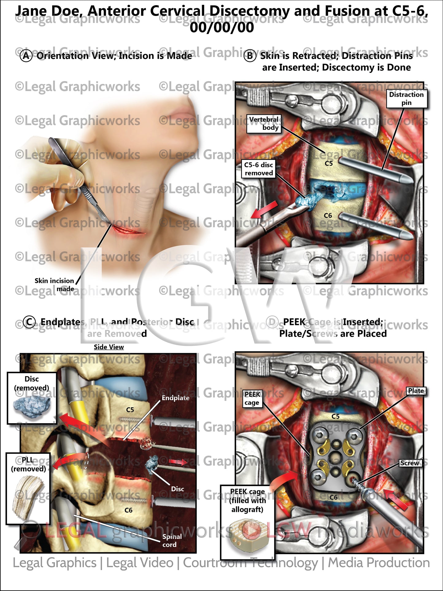 Anterior Cervical Discectomy and Fusion at C5-6