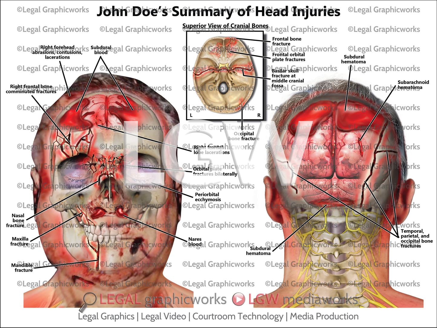 Summary of Head Injuries