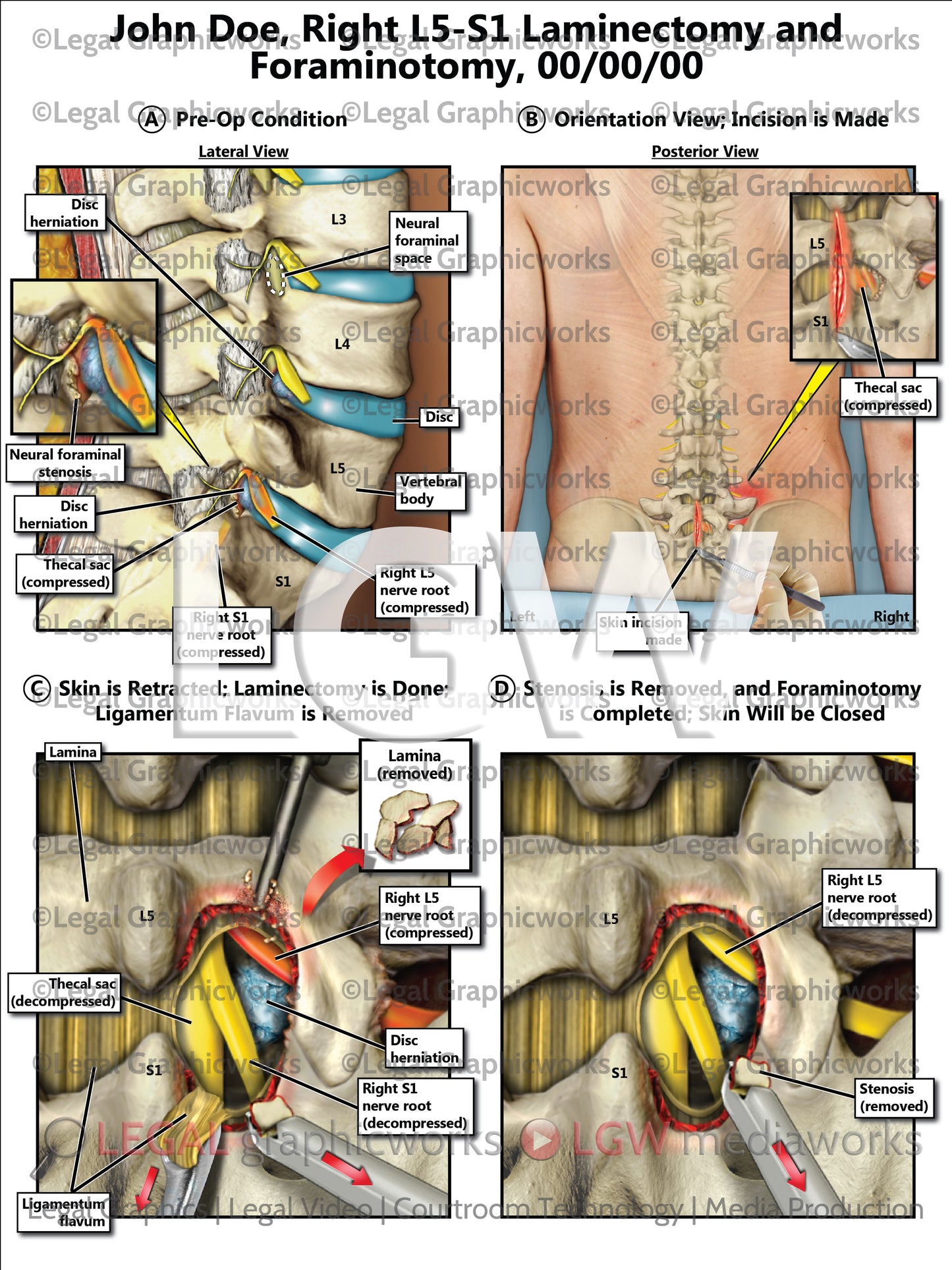 Right L5-S1 Laminectomy and Foraminotomy