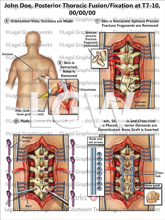 Posterior Thoracic Fusion/Fixation at T7-10