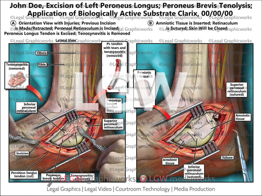 Excision of Left Peroneus Longus; Peroneus Brevis Tenolysis; Application of Biologically Active Substrate Clarix