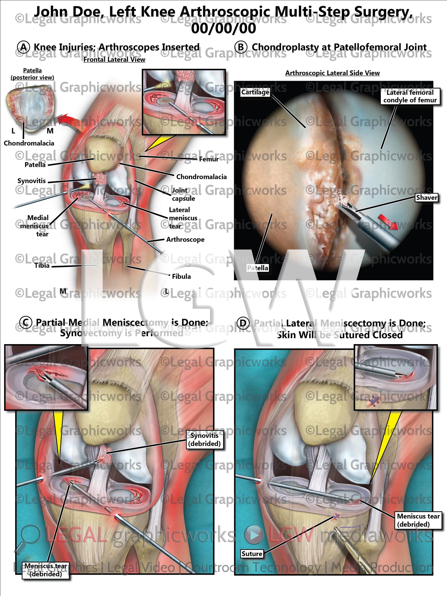 Left Knee Arthroscopic Multi-Step Surgery