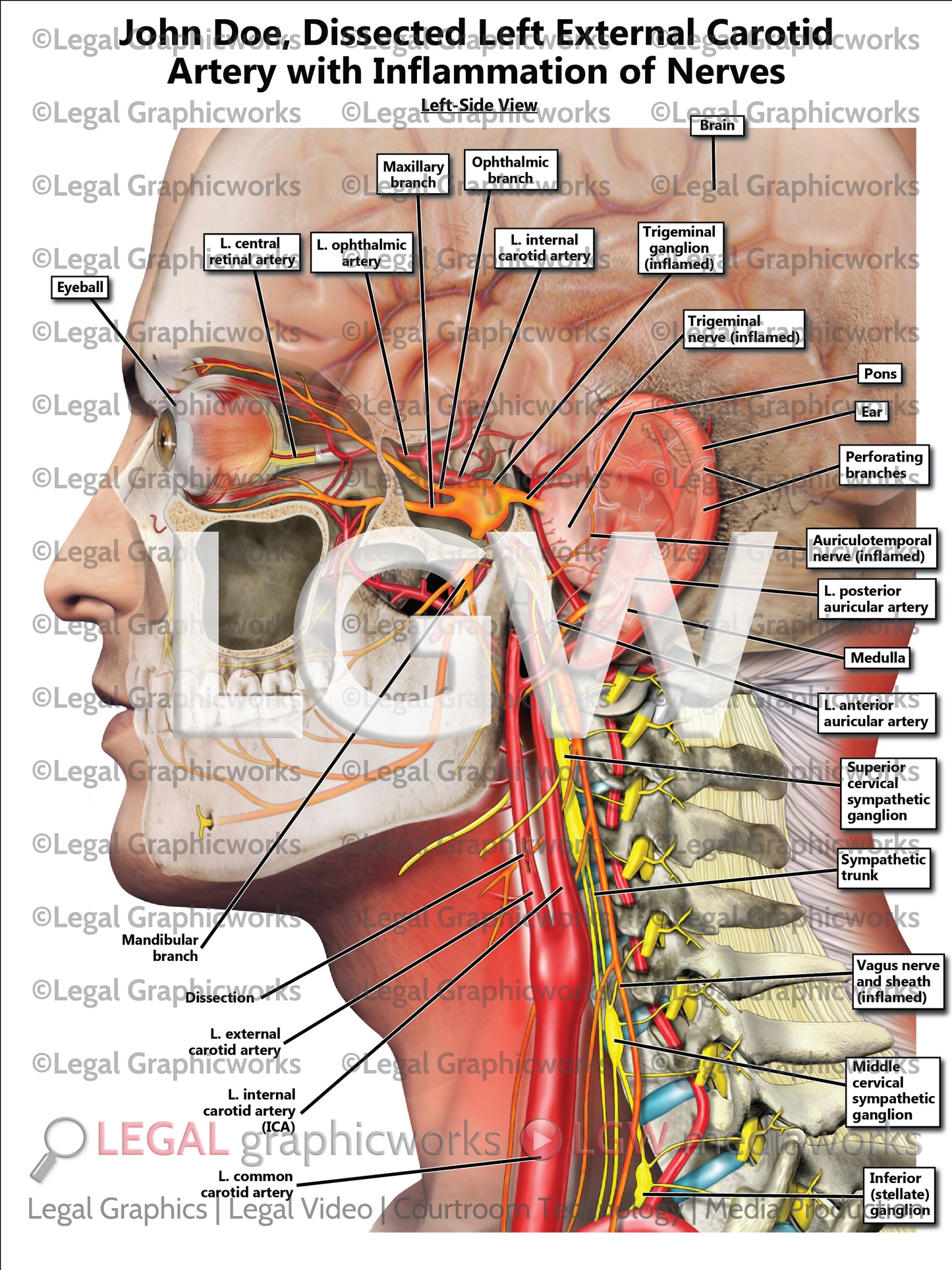 Dissected Left External Carotid Artery with Inflammation of Nerves