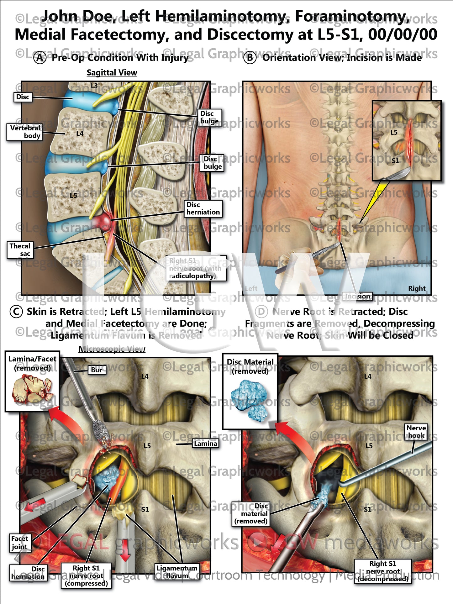 Left Hemilaminotomy, Foraminotomy, Medial Facetectomy, and Discectomy at L5-S1
