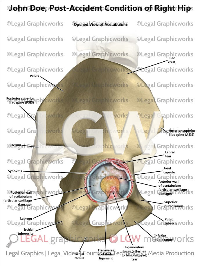 Post-Accident Condition of Right Hip