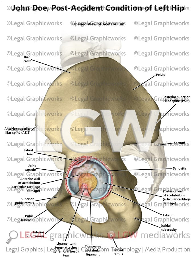 Post-Accident Condition of Left Hip