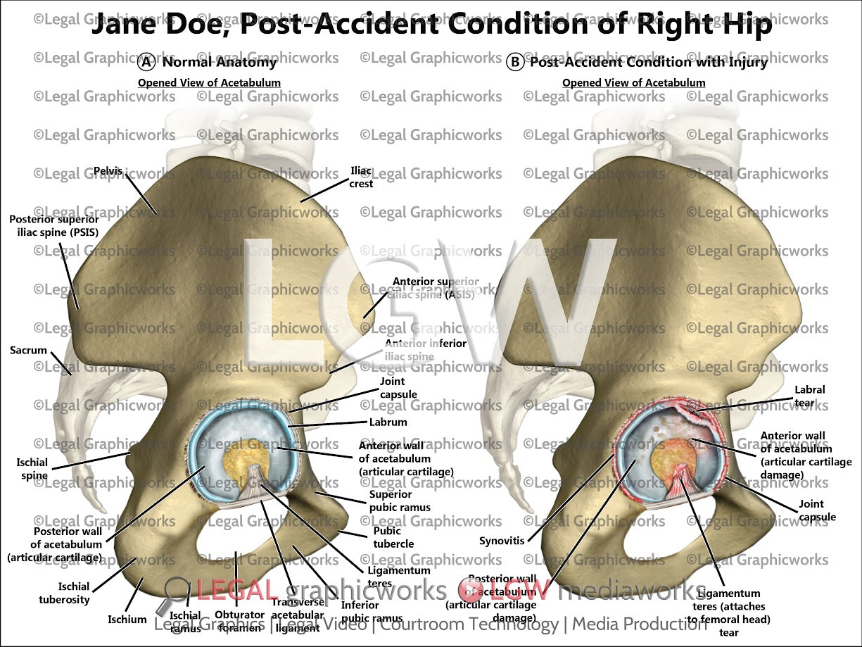 Post-Accident Condition of Right Hip