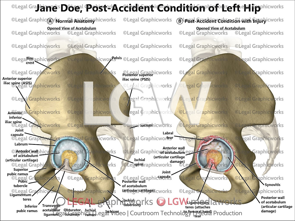 Post-Accident Condition of Left Hip