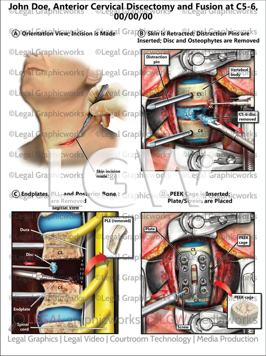 Anterior Cervical Discectomy and Fusion at C5-6