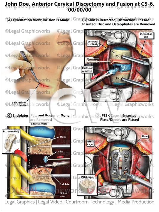 Anterior Cervical Discectomy and Fusion at C5-6