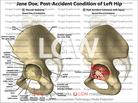 Post-Accident Condition of Left Hip