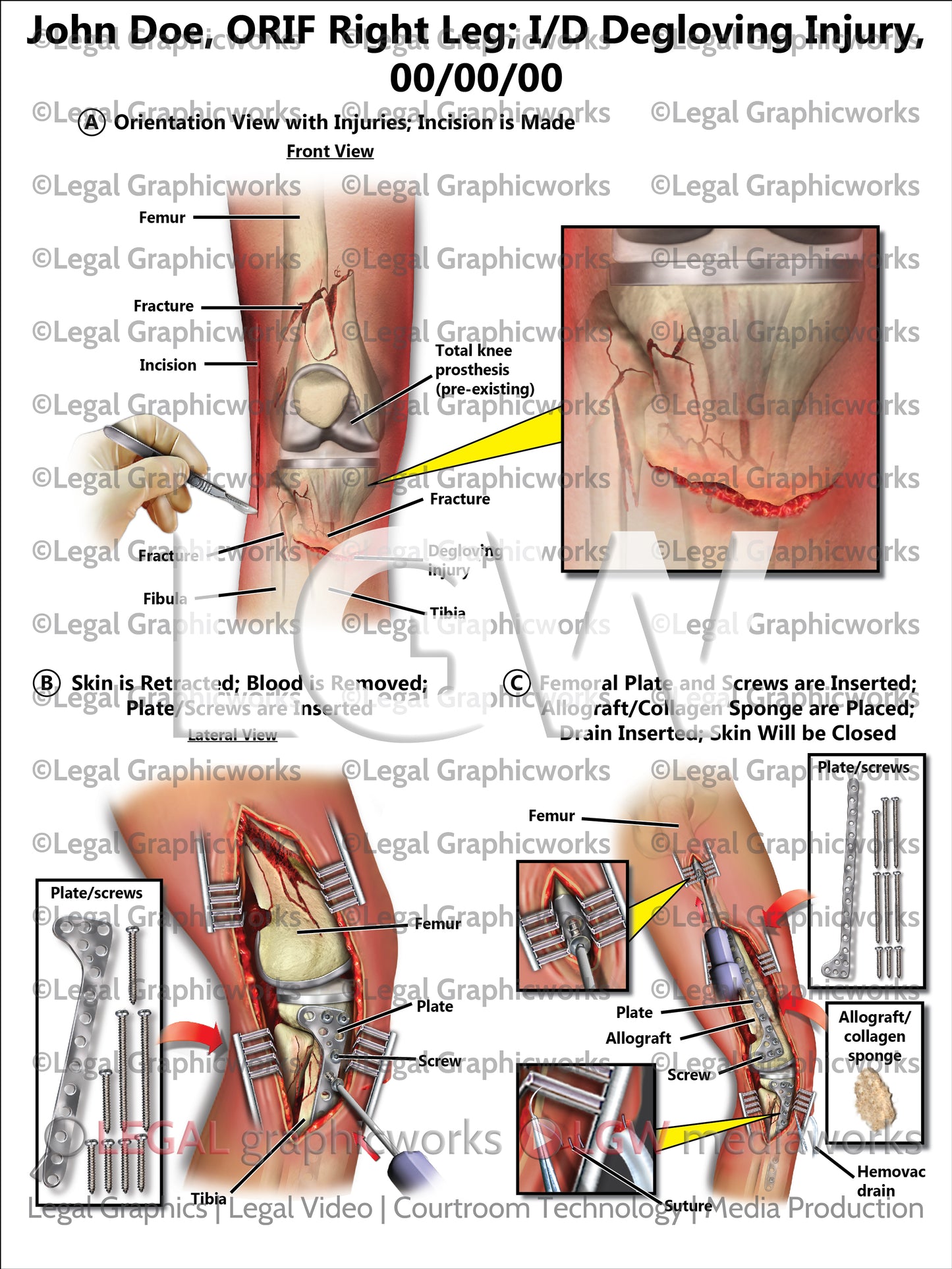 ORIF Right Leg; I/D Degloving Injury