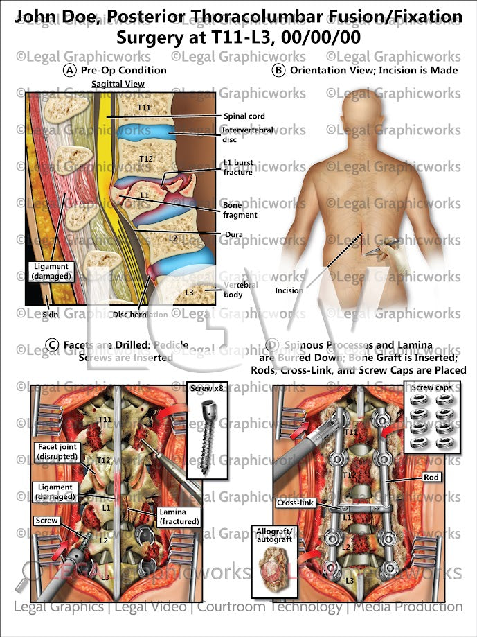 Posterior Thoracolumbar Fusion/Fixation Surgery at T11-L3