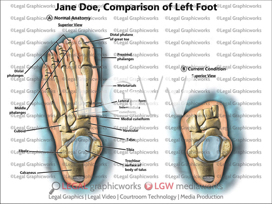 Comparison of Left Foot