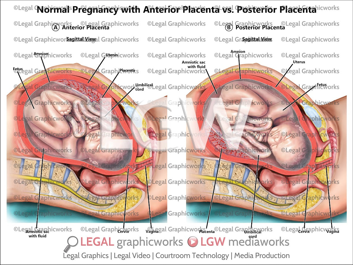 Normal Pregnancy with Anterior Placenta vs. Posterior Placenta