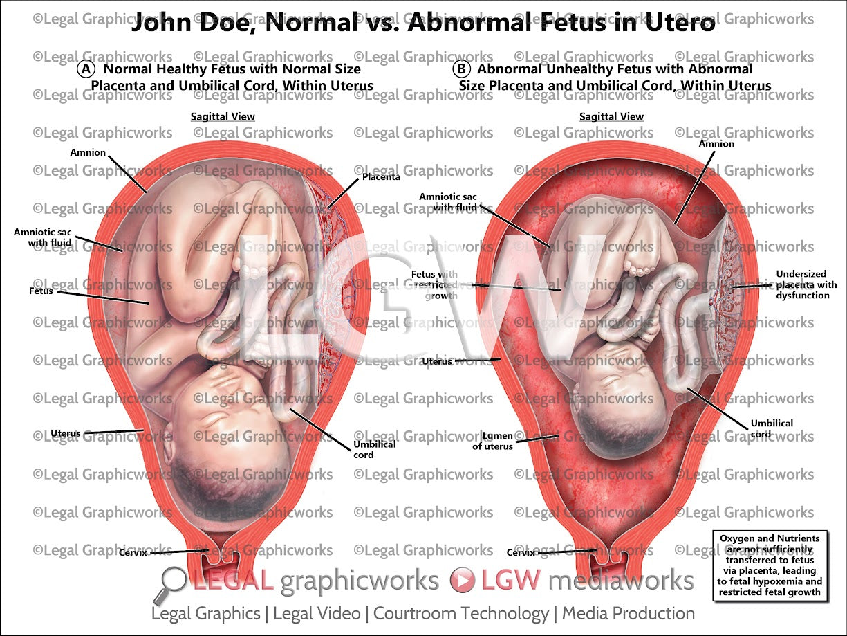 Normal vs. Abnormal Fetus in Utero