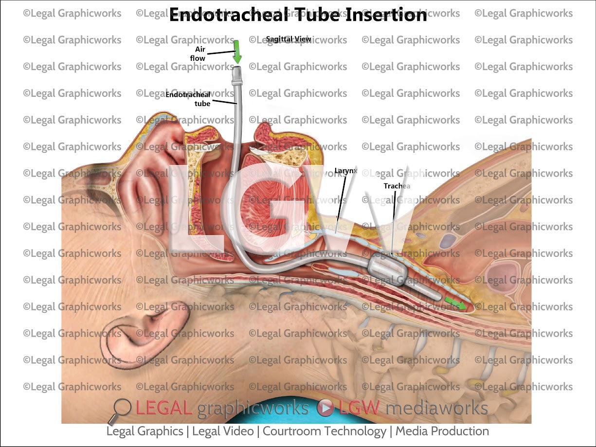 Endotracheal Tube Insertion