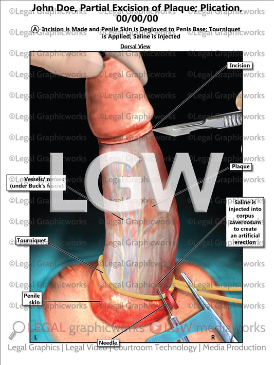 Partial Excision of Plaque; Plication