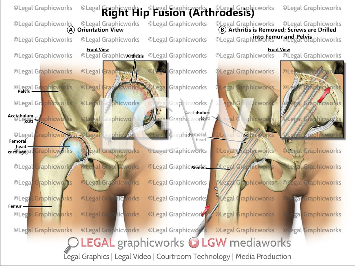 Right Hip Fusion (Arthrodesis)