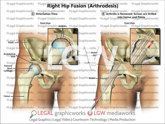 Right Hip Fusion (Arthrodesis)