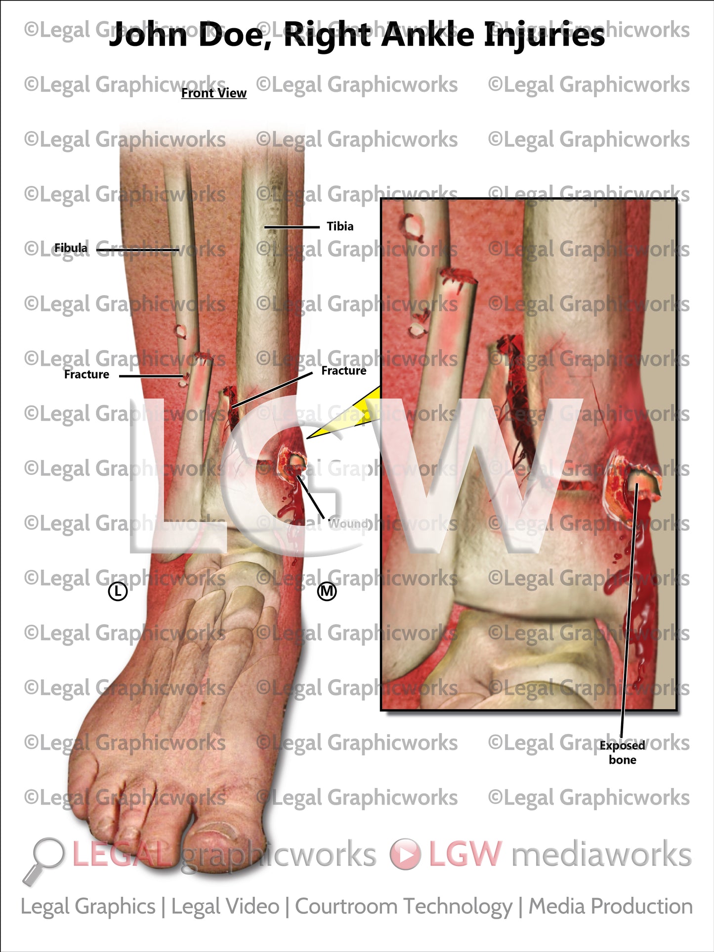 Right Ankle Injuries