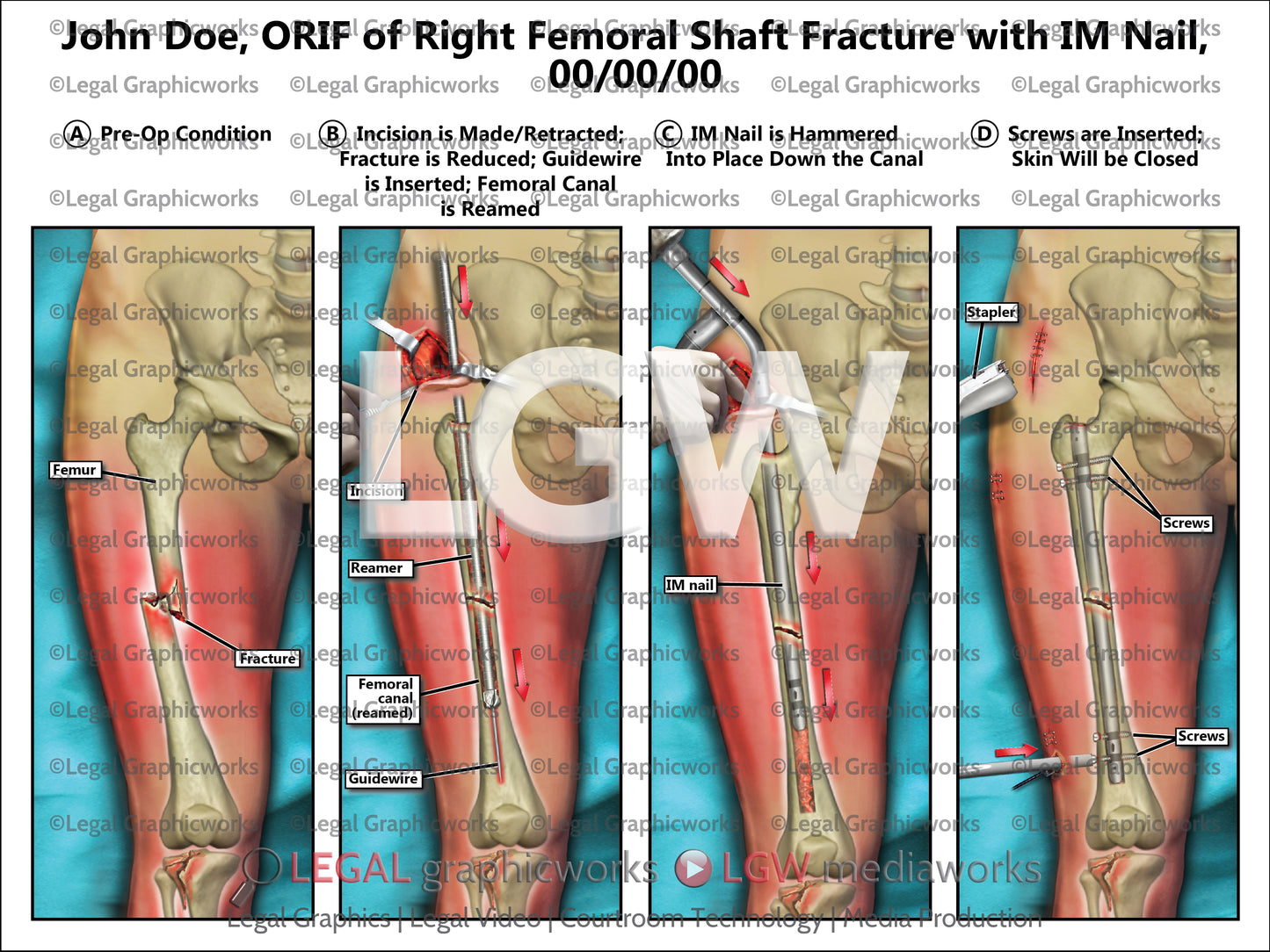 ORIF of Right Femoral Shaft Fracture with IM Nail