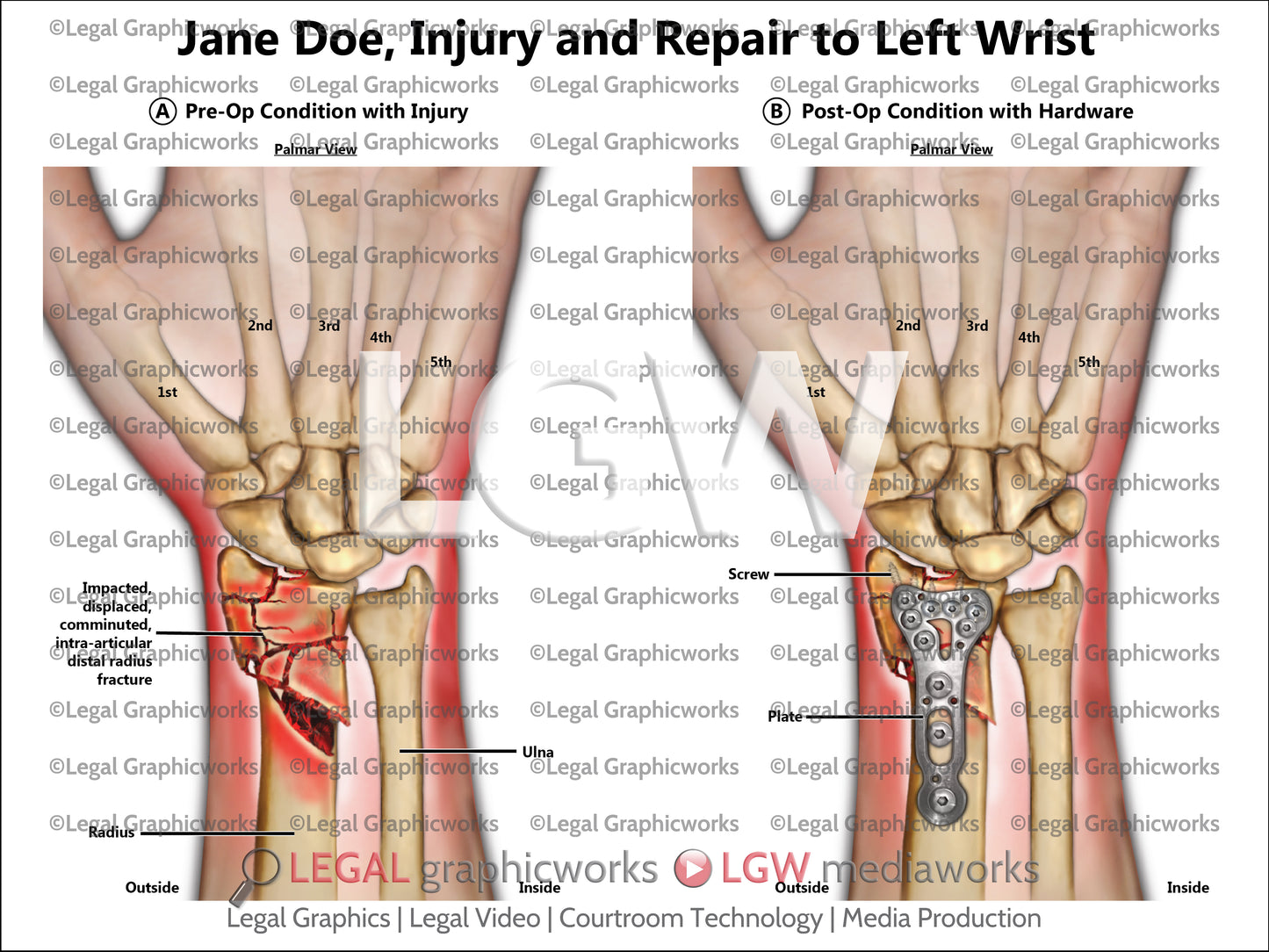 Injury and Repair to Left Wrist