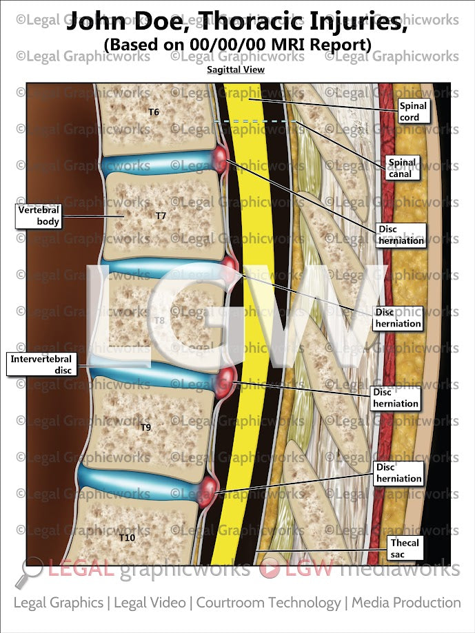 Thoracic Injuries