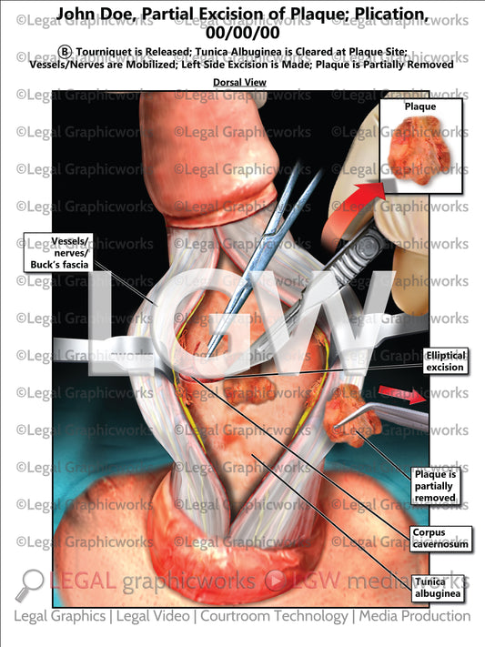 Partial Excision of Plaque; Plication