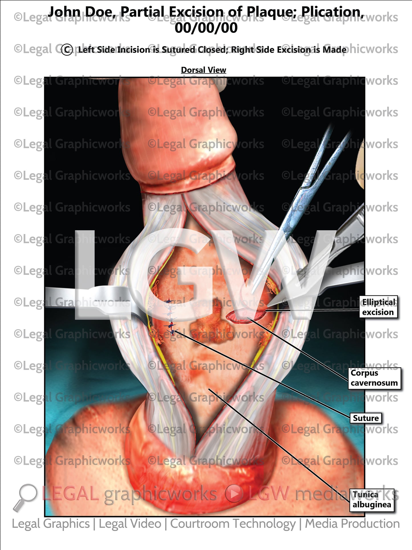 Partial Excision of Plaque; Plication