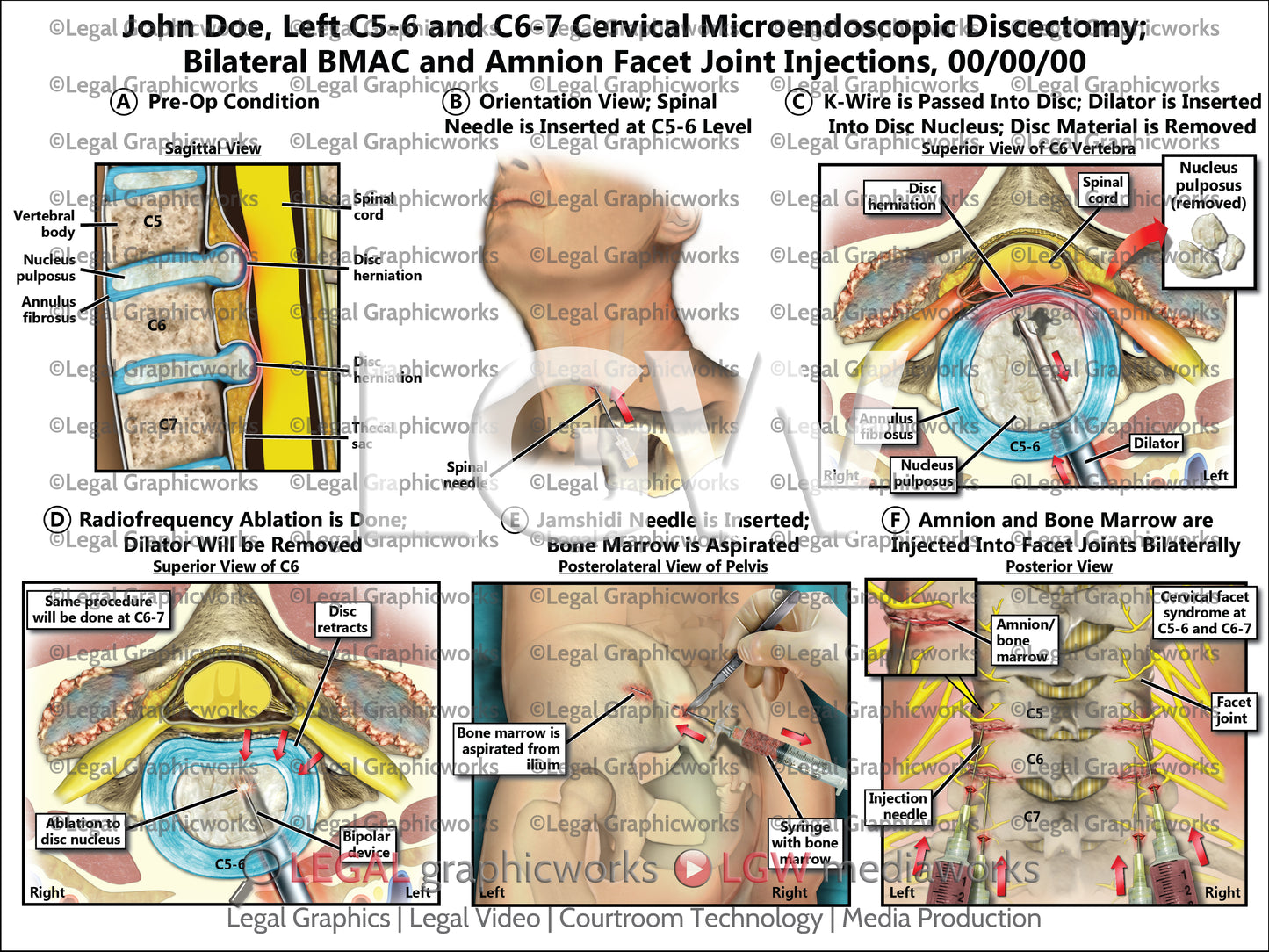 Left C5-6 and C6-7 Cervical Microendoscopic Discectomy; Bilateral BMAC and Amnion Facet Joint Injections