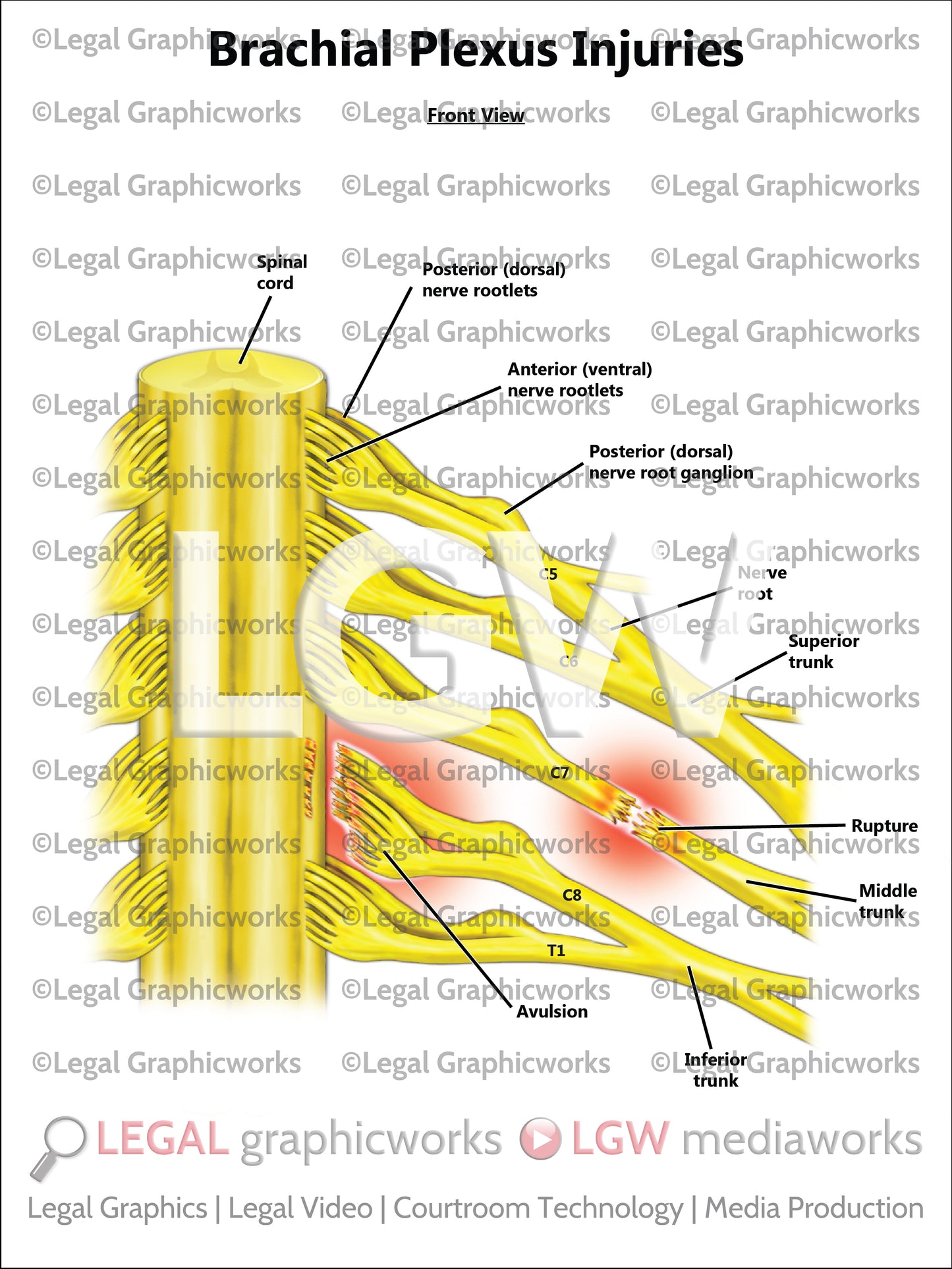 Brachial Plexus Injuries