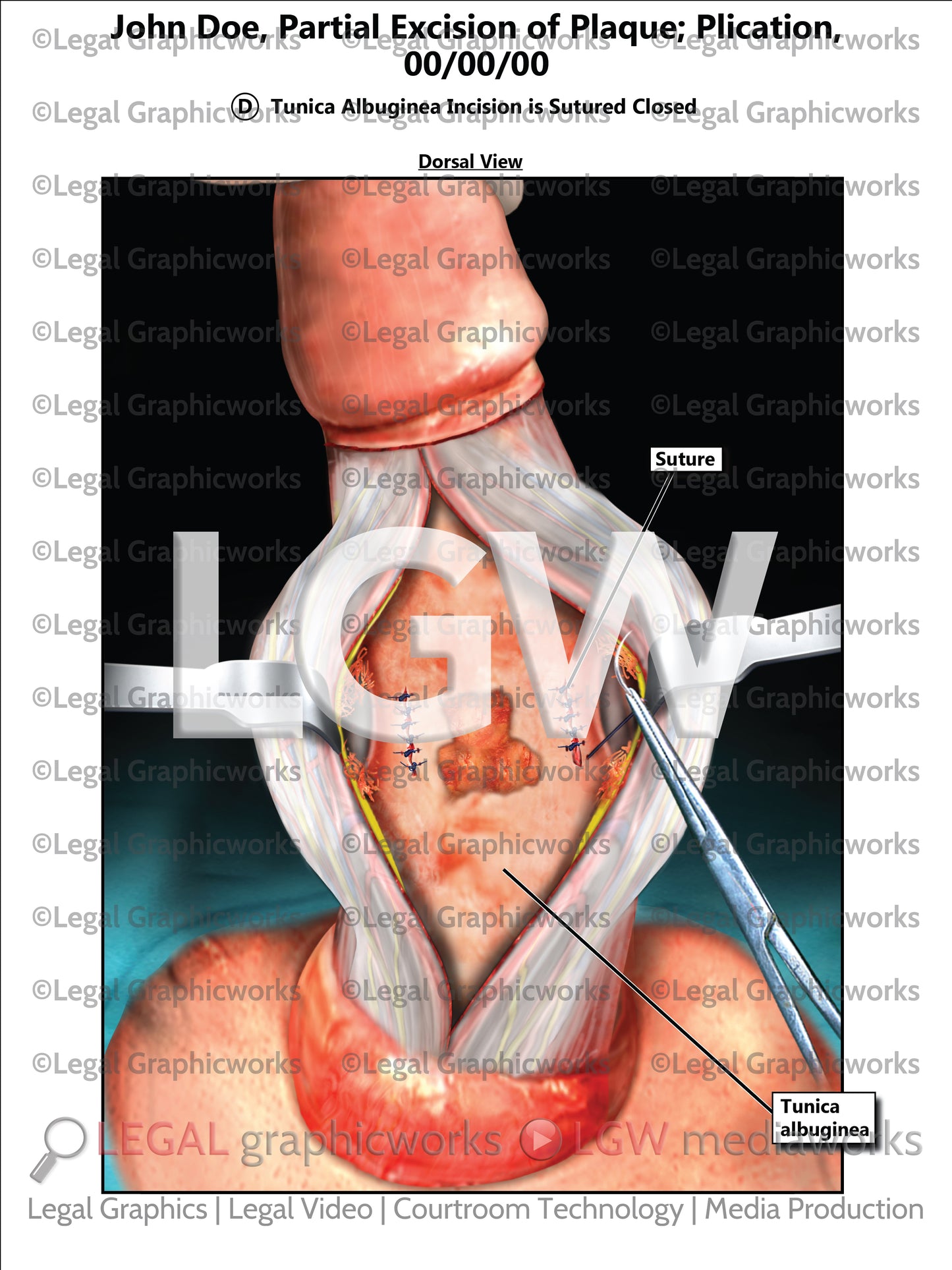 Partial Excision of Plaque; Plication