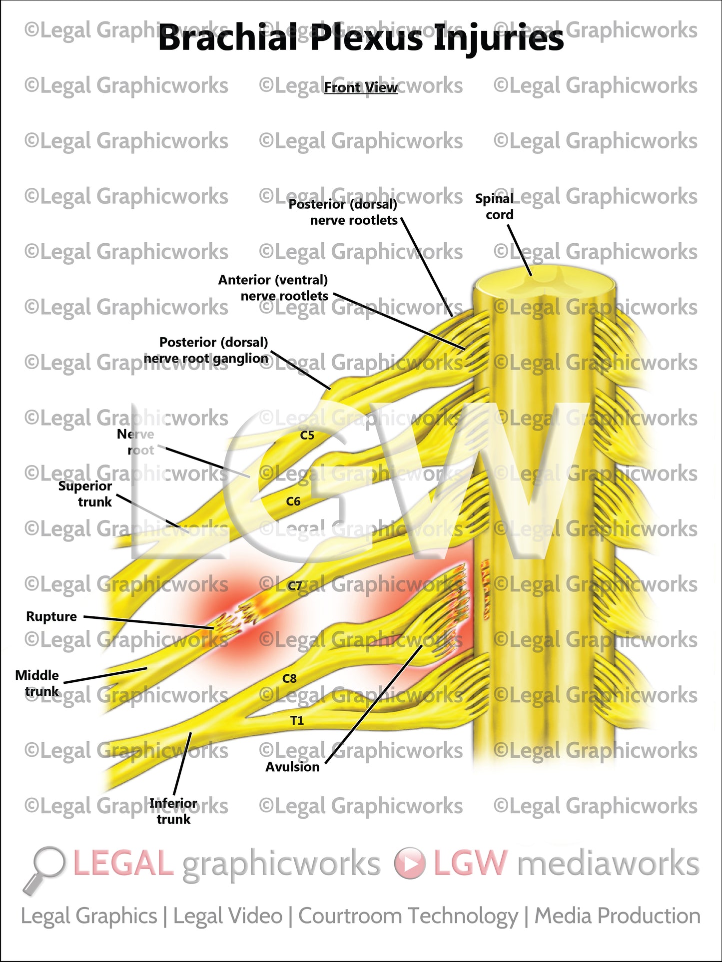 Brachial Plexus Injuries