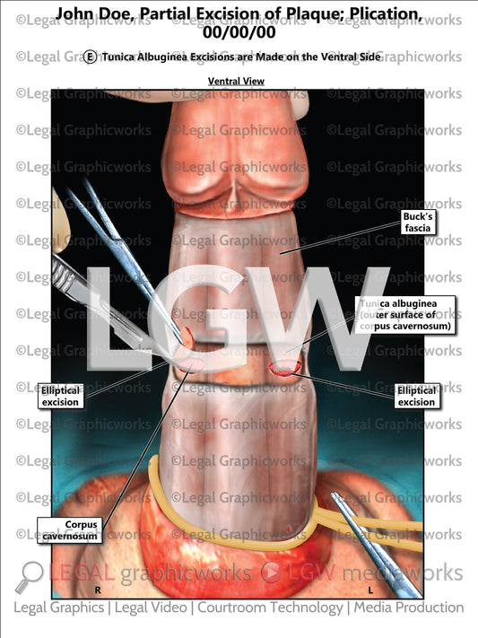 Partial Excision of Plaque; Plication