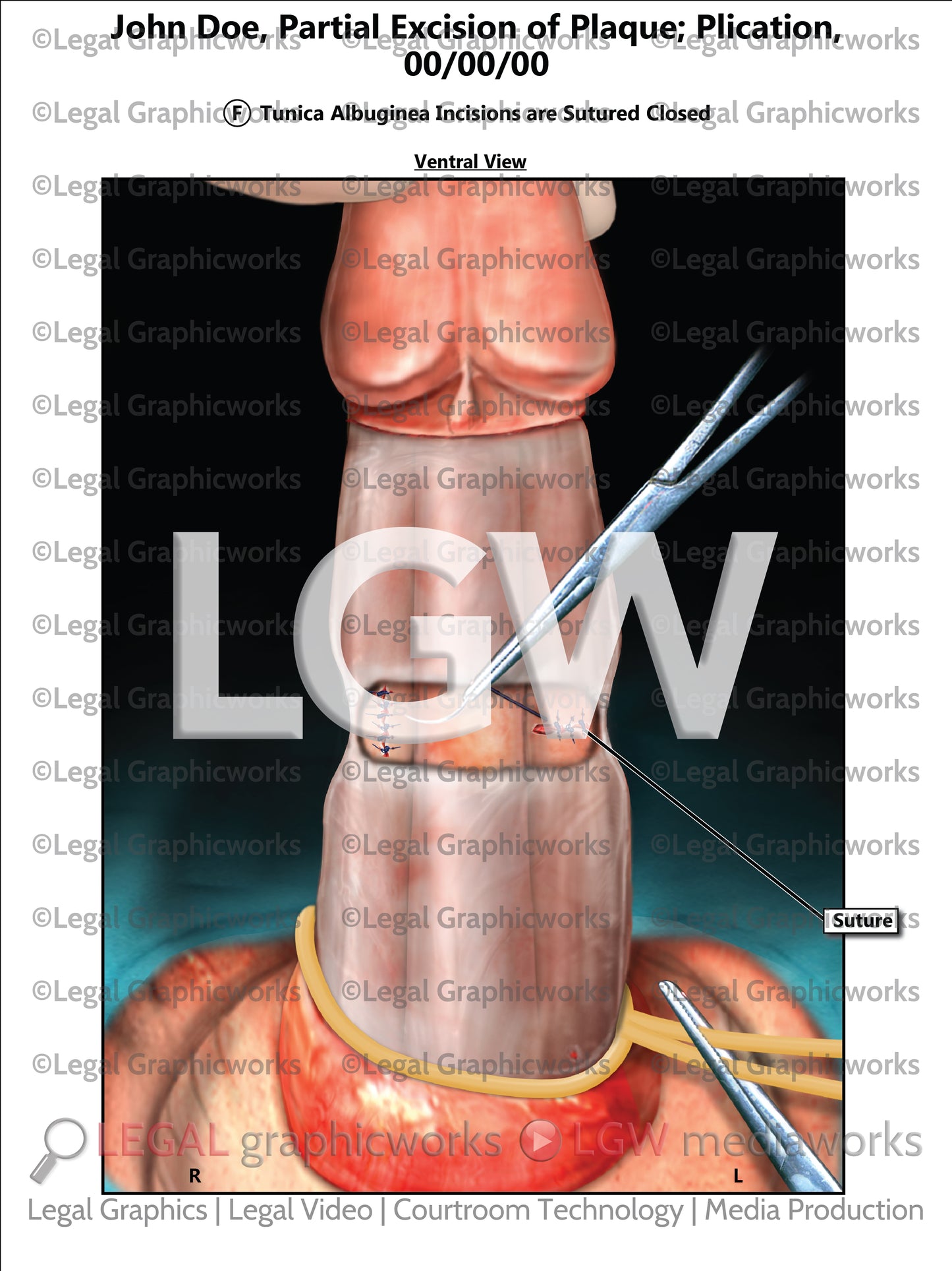 Partial Excision of Plaque; Plication