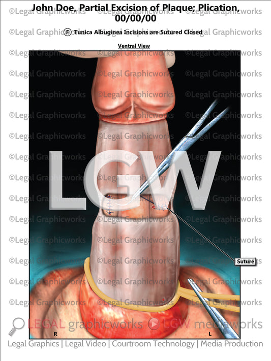 Partial Excision of Plaque; Plication